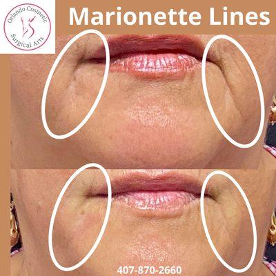 Marionette Lines - Fillers or Fat Transfer