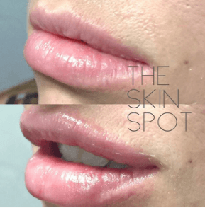 denverskinspotEnhancing the shape creating a beautiful Cupid's bow while looking natural.. #lips#natural#lipinjections#denver#cupidsbow#