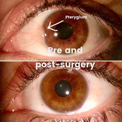 Pterygium surgery pre and post