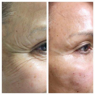 Botox treatment of crows feet!