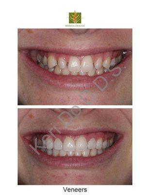 Gap closure with dental bonding on two teeth, no tooth structure removal. Time: 1 visit