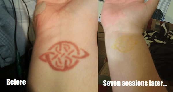 Red Celtic knot tattoo on my right wrist. The left is before, the right is after seven sessions at Vamoose.