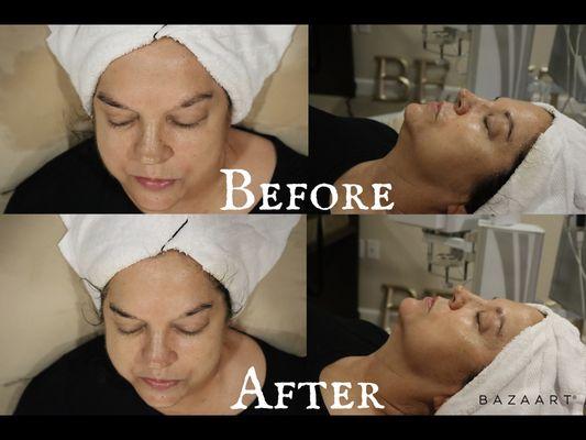 Before and After Hydrojelly and Ultrasonic/ Ultrasonic Spatula Treatments added on to Ultimate Radiance facial.