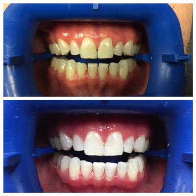 Zoom In office whitening results