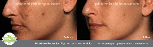 PicoSure FOCUS Skin Rejuvenation