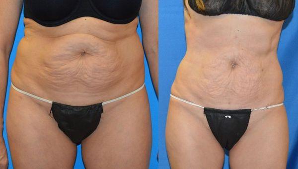 Abdominal and 'lovehandle' fat removal