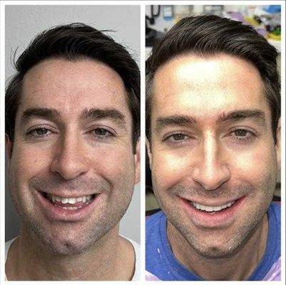 Original smile on left and my temporaries on right. New veneers coming in 2-3 weeks.