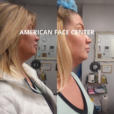 before and after of American Face Client