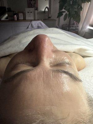 Post peel and Vampire Lactic Acid infusion Treatment