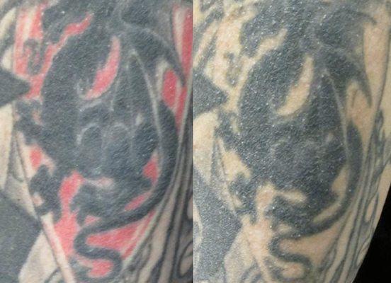 Tattoo Removal