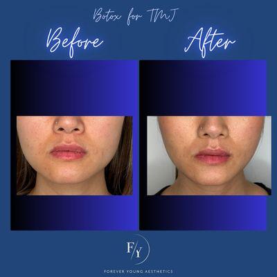 Jaw facial slimming/TMJ Botox treatment
#botoxmasseter