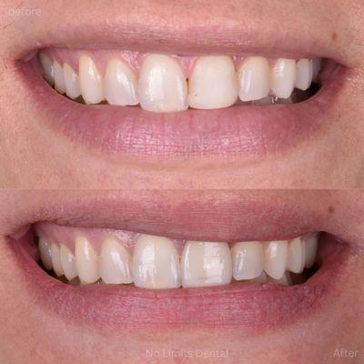 This patient had a bonding on one front tooth that would break every couple of years. We replaced the bonding with 1 well matched veneer.