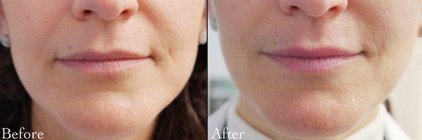 Before-After of Dermal Fillers