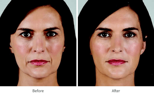 JUVÉDERM® can help fill  lines and give you natural-looking results that last.