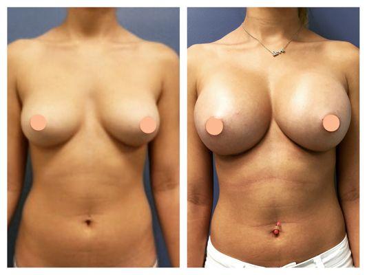 Breast Augmentation Silicone