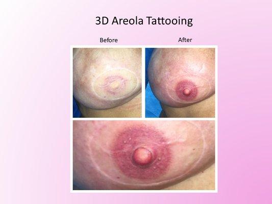 3 D Areola Tattoo