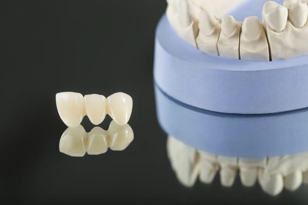 Porcelain Layered Zirconia Bridge