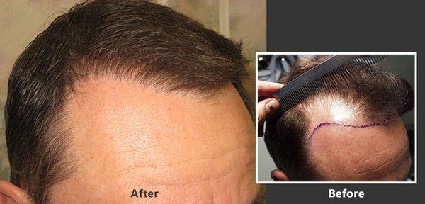 Timothy Carman, MD - La Jolla Hair Restoration