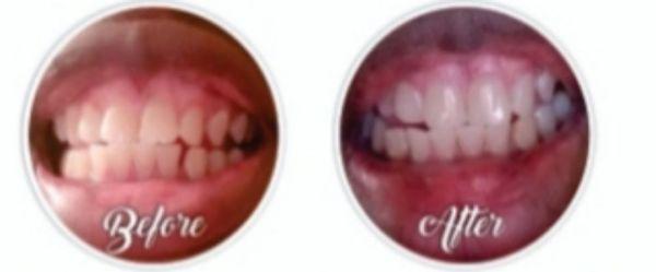 Amazing results from a 90 minute teeth whitening session