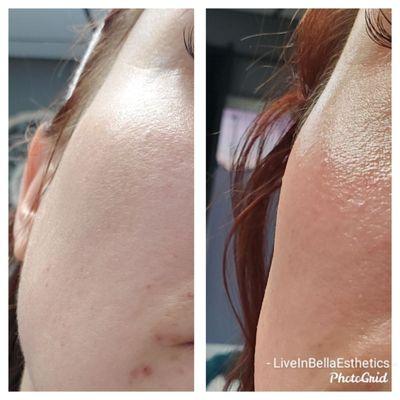 Before and After of a Dermaplane Facial. Vellus hair and dead skin cells are removed.