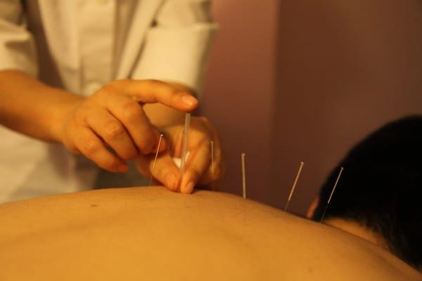 Dr. Grace doing acupuncture.