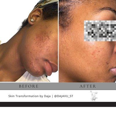 Acne Bootcamp results