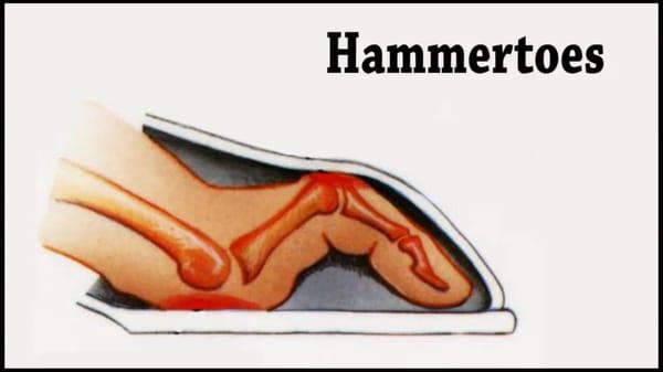 Treating Hammertoes at Adler Footcare