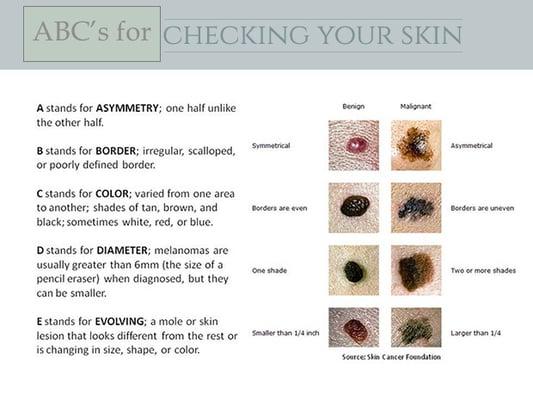 Skin Cancer Signs To Check For