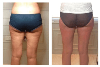 Lipo Cavitation