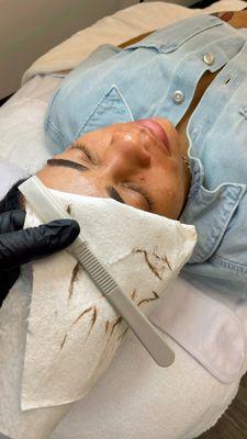 Dermaplaning Treatment