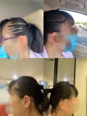 Hair loss treatment after 4 months