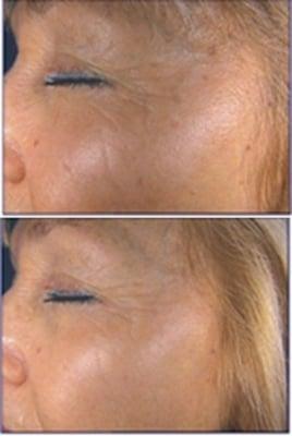 Before and After IPL PhotoFacial Rejuvenation