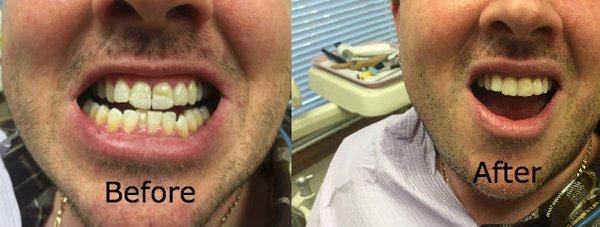 Before and after pictures of one of Dr. Orlandini's cosmetic dentistry patients.