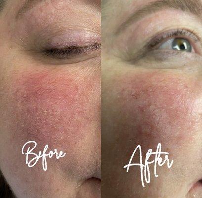 Rosacea Before & After TX