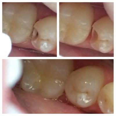 cavity/tooth decay fixed with tooth colored filling