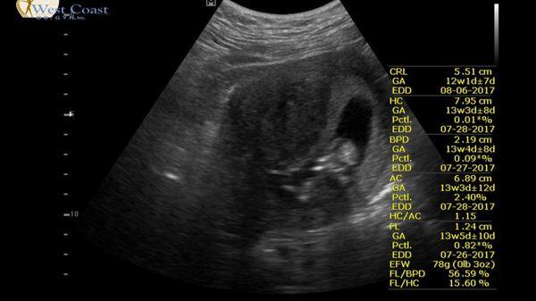 This is my 13 week 3 day ultrasound image from West Coast OB. You can see the difference in quality.