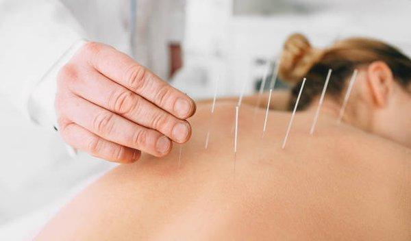 This is one of the Ancient Asia Acupuncture method to help people who have back pain, We use needles to stimulate the meridian of body.