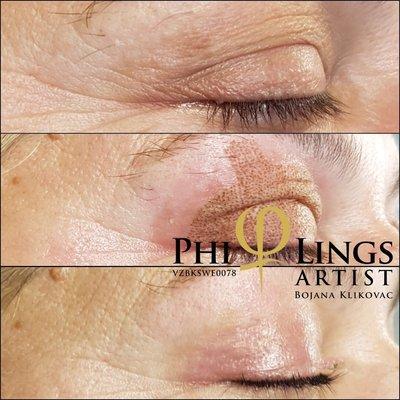 Eyelids lift with plasma ion