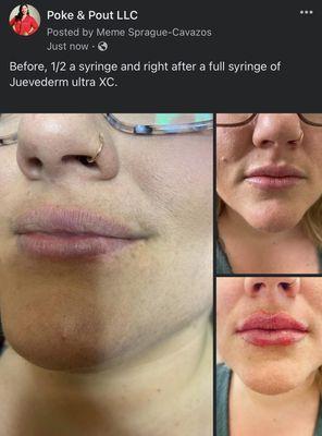 Lip filler/ Lip Augmentation