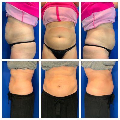 CoolSculpting Treatment to abdomen. Top = Before treatment; Bottom = approx 3 months after ONE treatment.