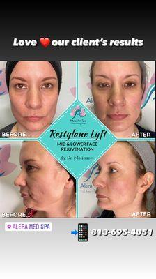 Mid and lower face rejuvenation with Restylane Lyft