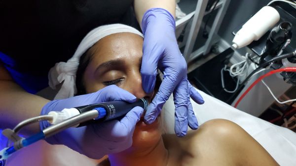 Hydrafacial