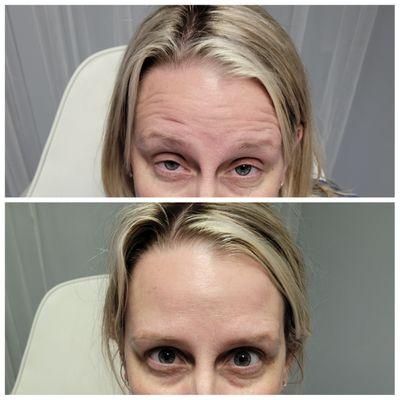 Before and after anti-wrinkle injections with botox!