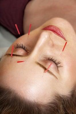 Facial Acupuncture improves skin and muscle tone, leaving you looking fabulous.