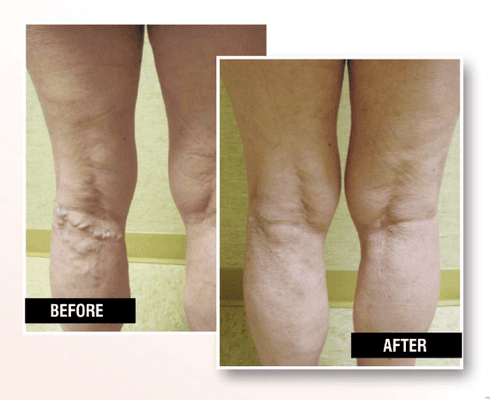 Get varicose veins treatment without surgery at USA Vein Clinics