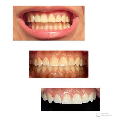 Patient requested even and sharper canine teeth, so mission accomplished in bottom two pictures.