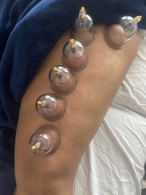 Cupping therapy