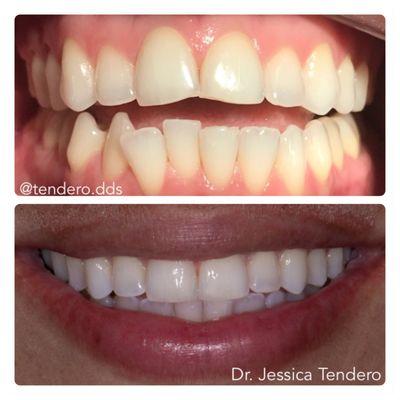 Invisalign + Whitening