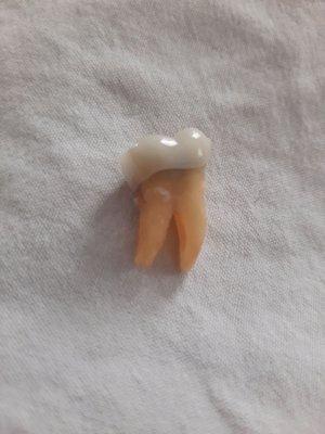 Tooth Extracted