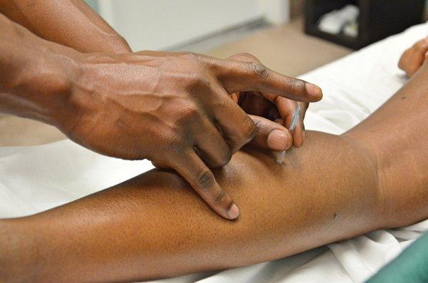 Trigger-point Dry Needling